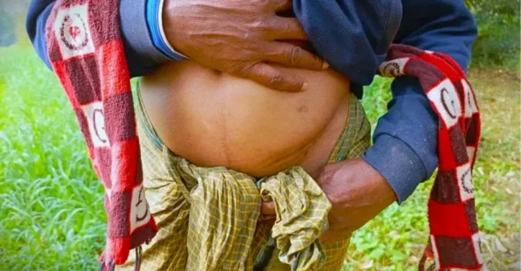 বাংলাদেশে ‘এক কিডনির গ্রাম’, দালাল চক্রের ফাঁদে নিঃস্ব দরিদ্র মানুষ